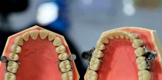 insolito, viral, dieta, metodo, iman, dispositivo dental, dentalslim diet control, twitter,