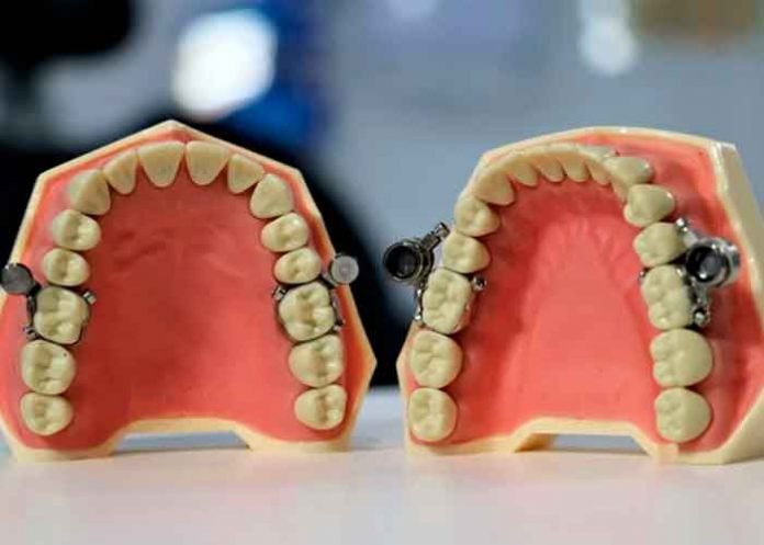 insolito, viral, dieta, metodo, iman, dispositivo dental, dentalslim diet control, twitter,