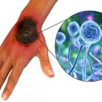 uruguay, mucormicosis, hongo negro, enfermedades,