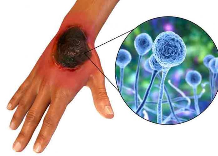 uruguay, mucormicosis, hongo negro, enfermedades,