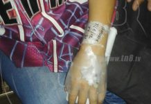 Carazo: Niño atacado por Pitbull en estado delicado