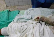 Honduras: Mujer quema a su cuñada con agua hirviendo