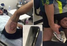 Ciclista sufre quemaduras en la pierna tras explotar su iPhone