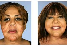 Reconstruyen rostro de transgénero a quien le inyectaron cemento