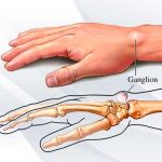 Ganglión, Causas, factores de riesgo, salud,
