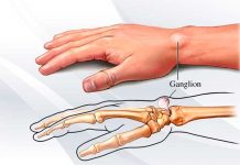 Ganglión: este tipo de quistes son benignos Ganglión, Causas, factores de riesgo, salud,
