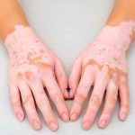 vitiligo, enfermedad, salud, manchas blancas,