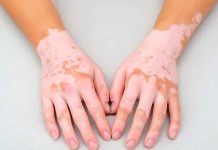 vitiligo, enfermedad, salud, manchas blancas,