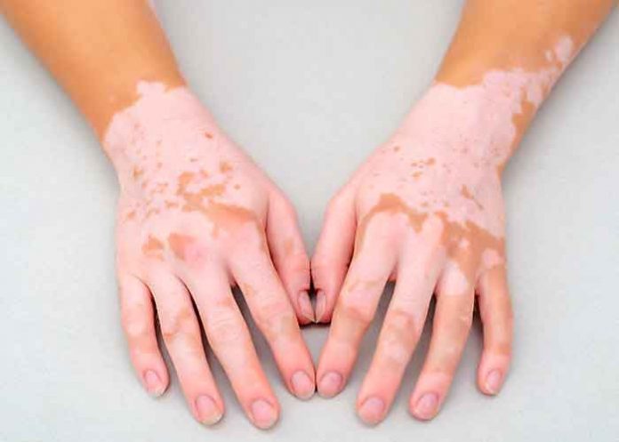 vitiligo, enfermedad, salud, manchas blancas,