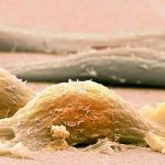 salud, sarcoma, sintomas, tratamiento, cancer