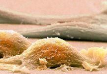 Conocé este tipo de cáncer con más de 150 variedades salud, sarcoma, sintomas, tratamiento, cancer