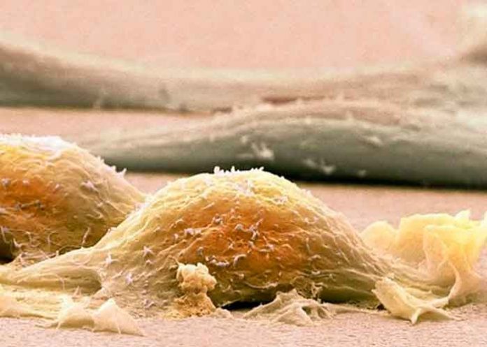 salud, sarcoma, sintomas, tratamiento, cancer