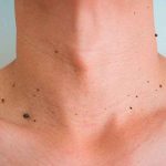 Elimina las verrugas de una forma fácil e indolora salud, verrugas, tratamiento,