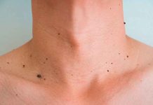 Elimina las verrugas de una forma fácil e indolora salud, verrugas, tratamiento,