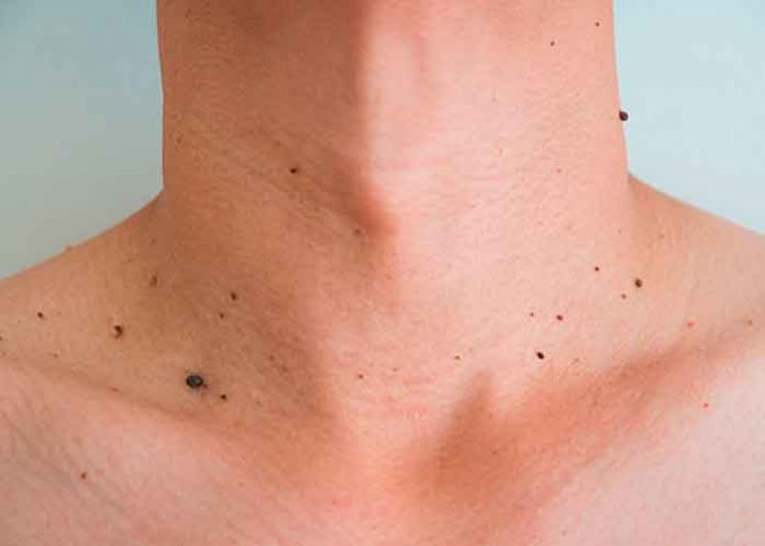 salud, verrugas, tratamiento,