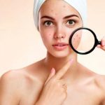 Consejos para tratar el acné según la zona afectada Foto: Consejos para tratar el acné según la zona afectada / Referencia