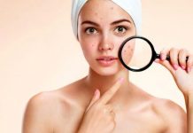 Consejos para tratar el acné según la zona afectada Foto: Consejos para tratar el acné según la zona afectada / Referencia