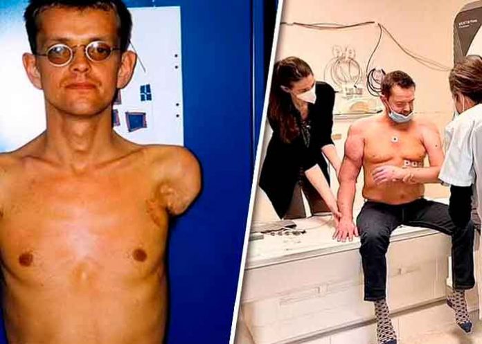 espana- ¡Wow! Hombre que recibió primer trasplante de brazos ya puede mover sus bíceps