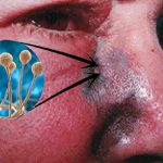 Honduras: Salud confirma un tercer caso por hongo negro Honduras: Salud confirma un tercer caso por hongo negro