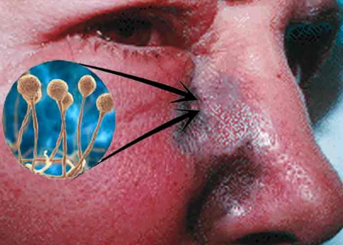 Honduras: Salud confirma un tercer caso por hongo negro