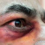 Hongo negro cobra segunda víctima en Honduras