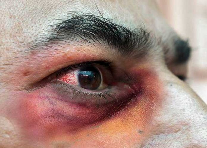 hongo-negro Hongo negro cobra segunda víctima en Honduras