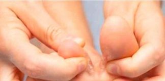 Hongos en los Pies