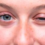 Ptosis o párpados caído: causas y factores de riesgo párpados, Ptosis, causa, riesgos, tratamiento,