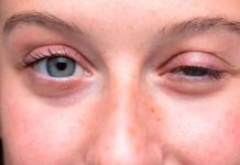 Ptosis o párpados caído: causas y factores de riesgo párpados, Ptosis, causa, riesgos, tratamiento,