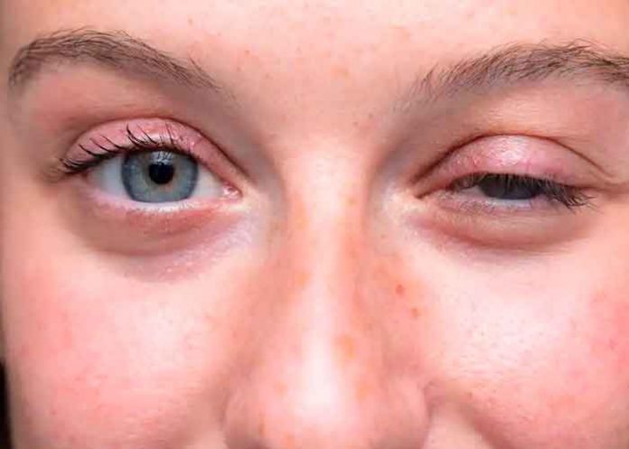 párpados, Ptosis, causa, riesgos, tratamiento,