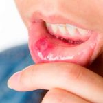 Mucositis oral: causas, síntomas y prevención mucositis oral, riesgos, causas, efectos,