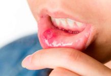 mucositis oral, riesgos, causas, efectos,