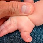 Rubinstein-Taibi, síndrome, diagnóstico, tratamiento,