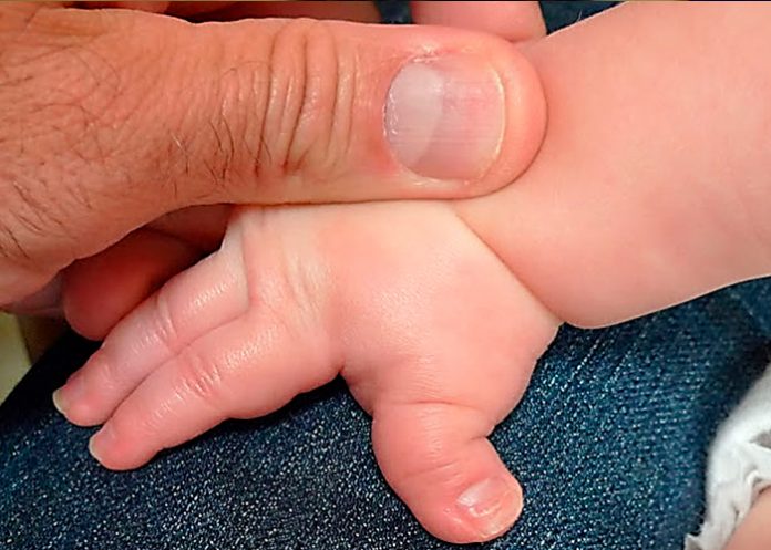 Rubinstein-Taibi, síndrome, diagnóstico, tratamiento,