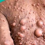 Mujer impacta al mundo al tener más de 200 tumores en todo su cuerpo