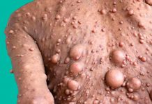 Mujer impacta al mundo por tener más de 200 tumores en todo su cuerpo Mujer impacta al mundo al tener más de 200 tumores en todo su cuerpo
