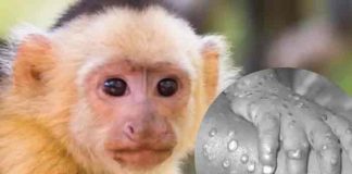 Identifican primer caso de viruela de mono en Texas, Estados Unidos