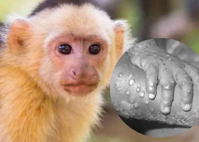viruela-de-mono- Identifican primer caso de viruela de mono en Texas, Estados Unidos