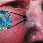 Honduras confirma un nuevo caso de hongo negro, ya suman 12 contagios Honduras confirma un nuevo caso de hongo negro, ya suman 12 contagios