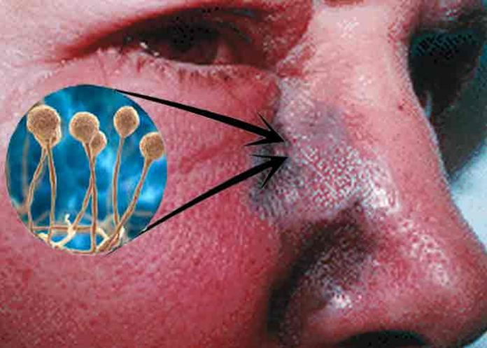 Honduras confirma un nuevo caso de hongo negro, ya suman 12 contagios