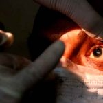 ¡Alerta! Detectan 8 nuevos casos de «Hongo Negro» en Honduras Paciente de "Hongo Negro" en tratamiento médico