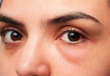 ¿Cómo evitar las ojeras? aquí te contamos como