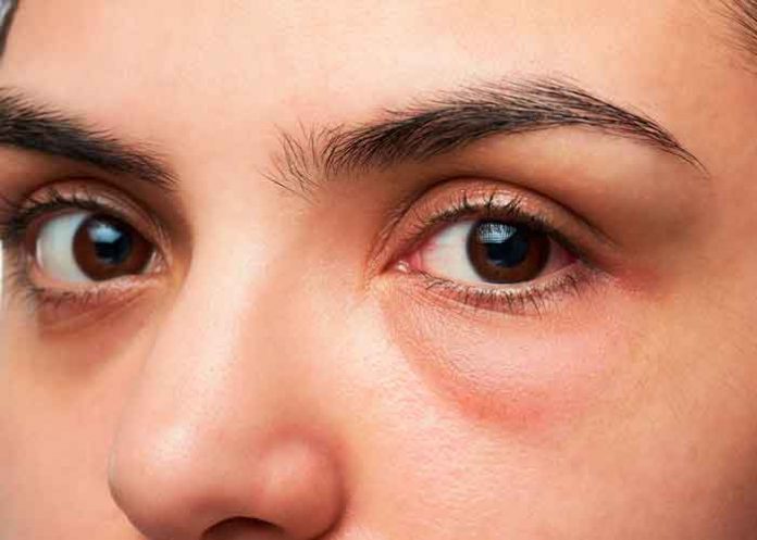 ¿Cómo evitar las ojeras? aquí te contamos como