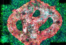 Tumor cerebral maligno impreso en 3D (VIDEO) Tumor bio impreso en 3D