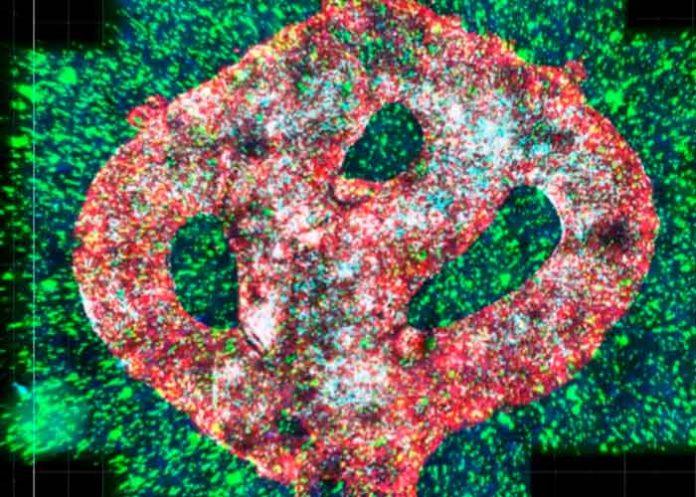 Tumor bio impreso en 3D