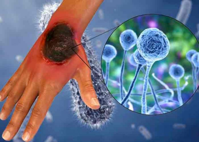 Salud de Honduras confirma tres nuevos casos de hongo negro