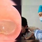 Mujer va al médico por dolor de oído y le hallan una araña viva Mujer va al médico por dolor de oído y le hallan una araña viva