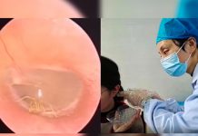Mujer va al médico por dolor de oído y le hallan una araña viva Mujer va al médico por dolor de oído y le hallan una araña viva