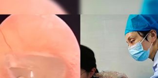 Mujer va al médico por dolor de oído y le hallan una araña viva