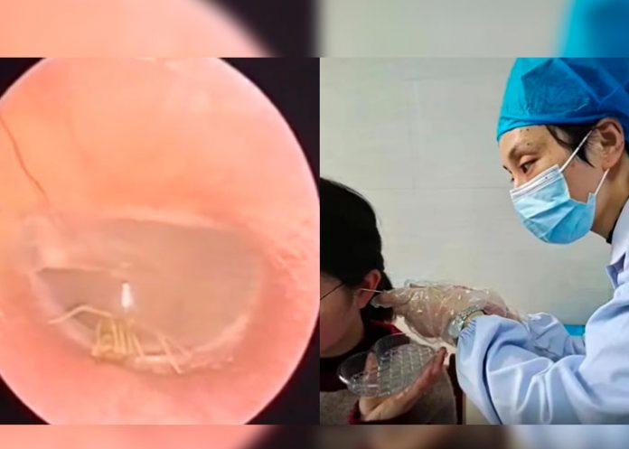 Mujer va al médico por dolor de oído y le hallan una araña viva